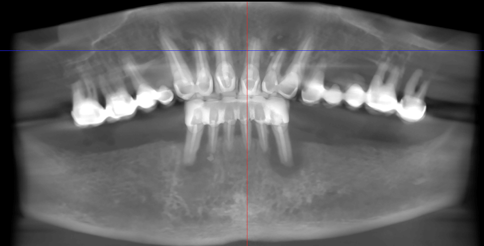 Тотальне протезування коронками на імплантах Straumann