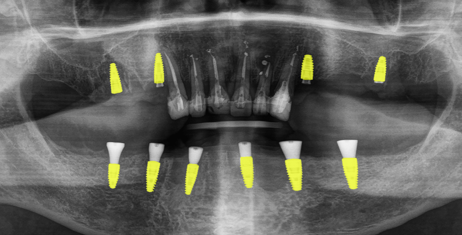 Тотальне протезування коронками на імплантах Straumann