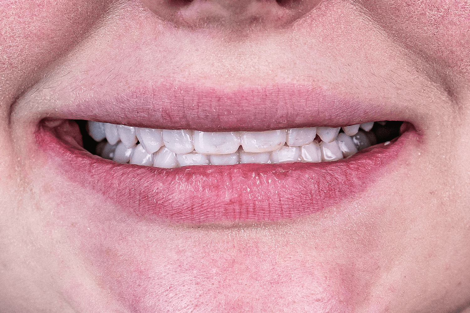 Тотальне протезування вінірами й коронками e.max