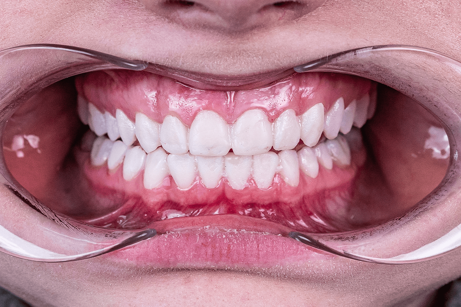 Тотальне протезування вінірами й коронками e.max