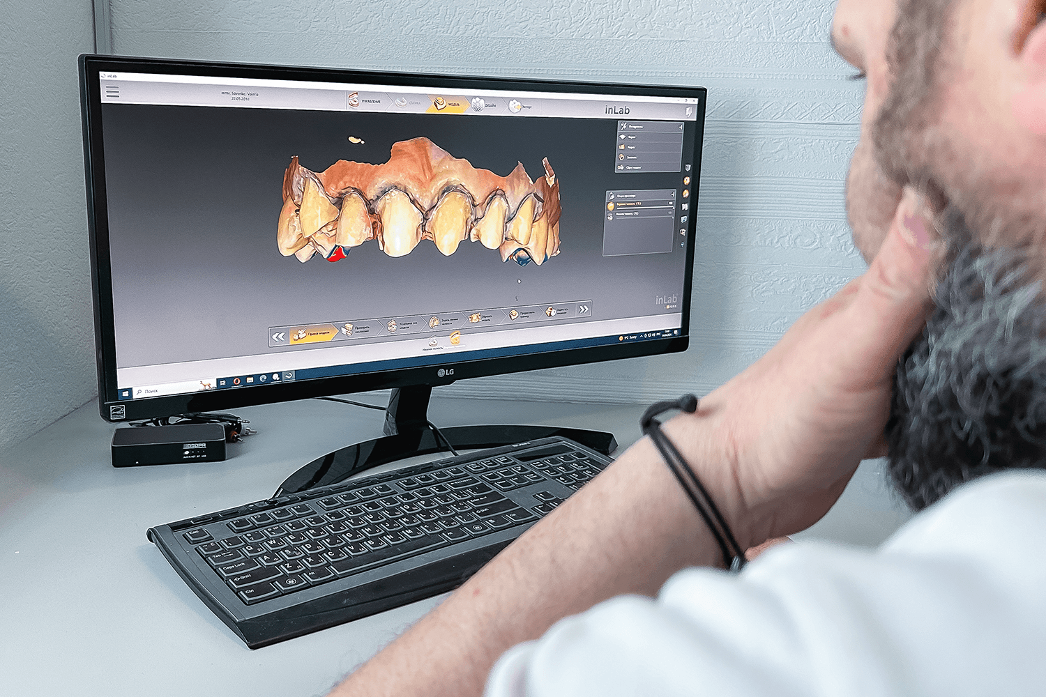Тотальне протезування вінірами й коронками e.max