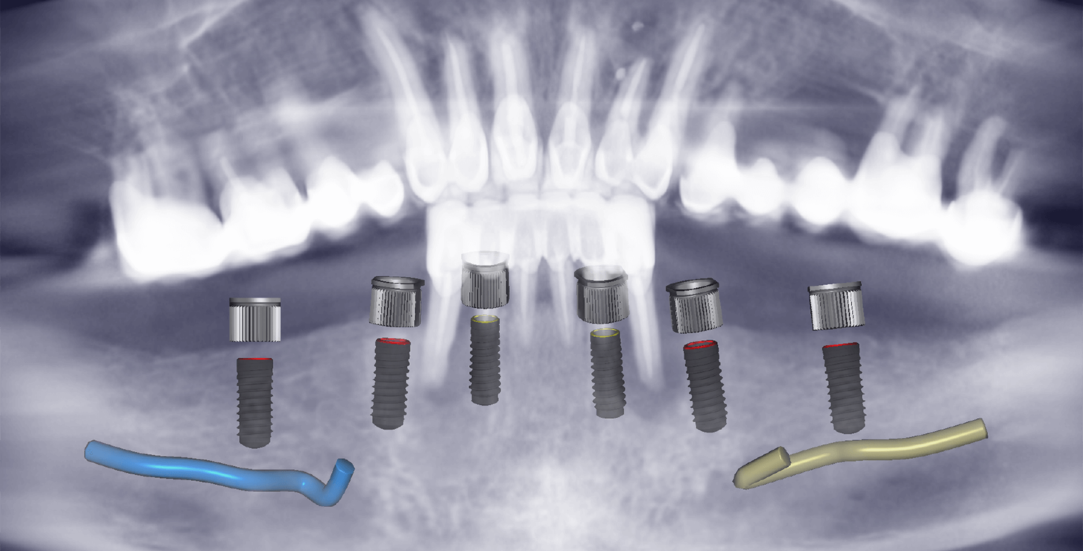 Тотальне протезування коронками на імплантах Straumann