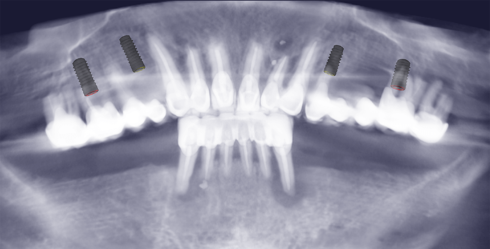 Тотальне протезування коронками на імплантах Straumann