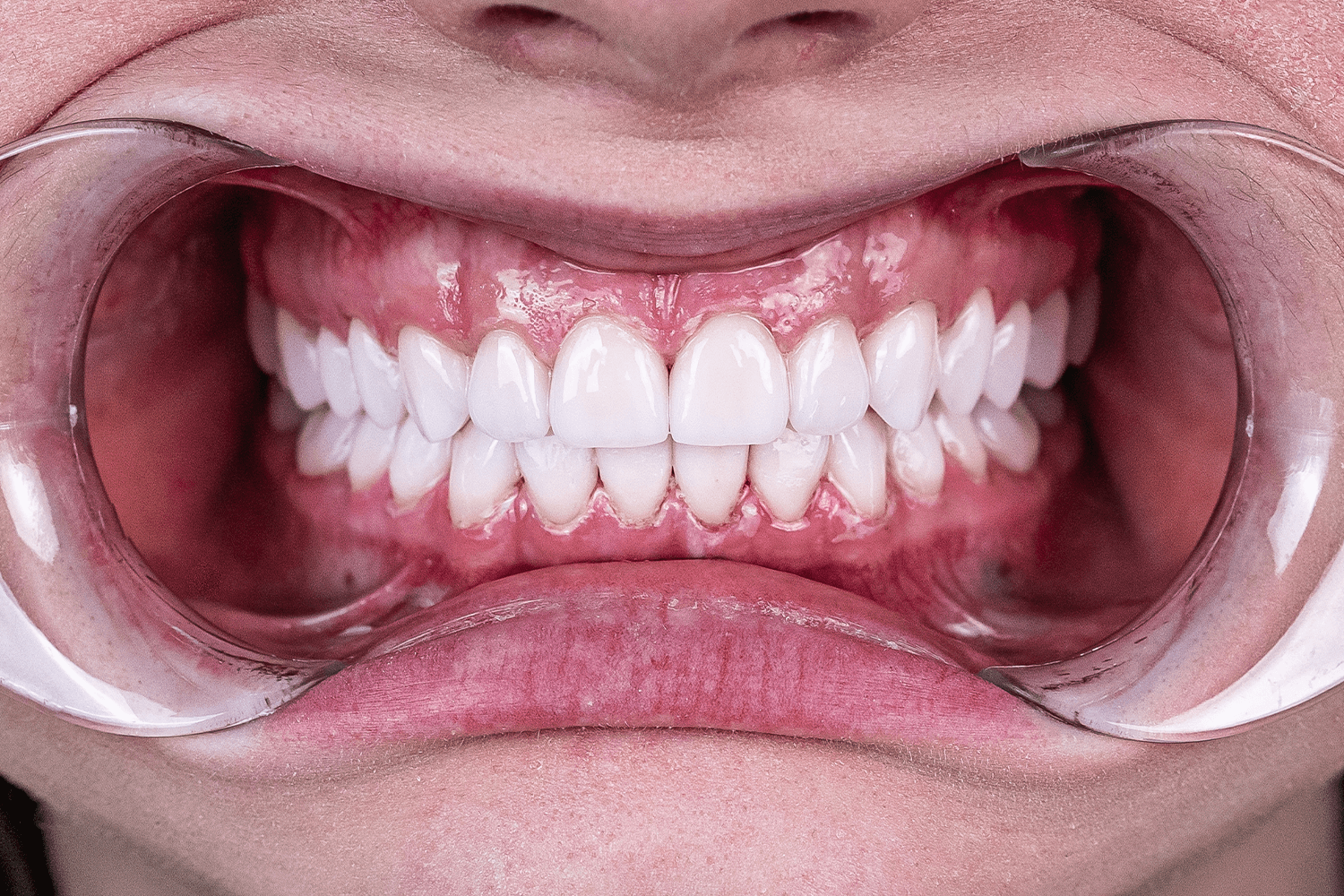 Тотальне протезування вінірами й коронками e.max