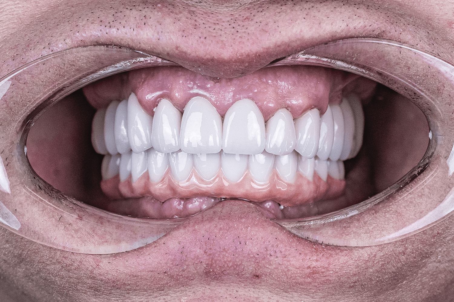 Тотальне протезування коронками на імплантах Straumann