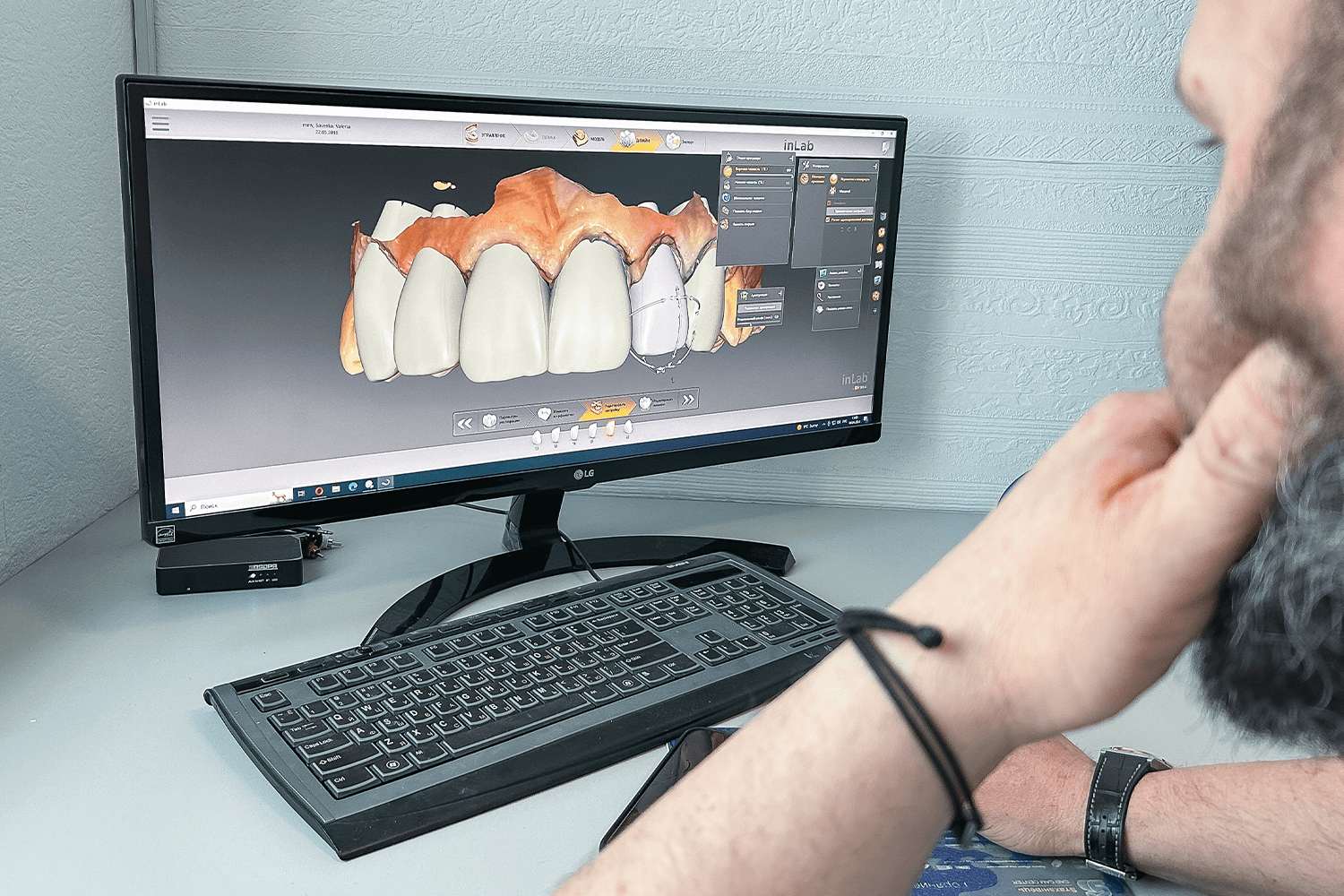 Тотальне протезування вінірами й коронками e.max