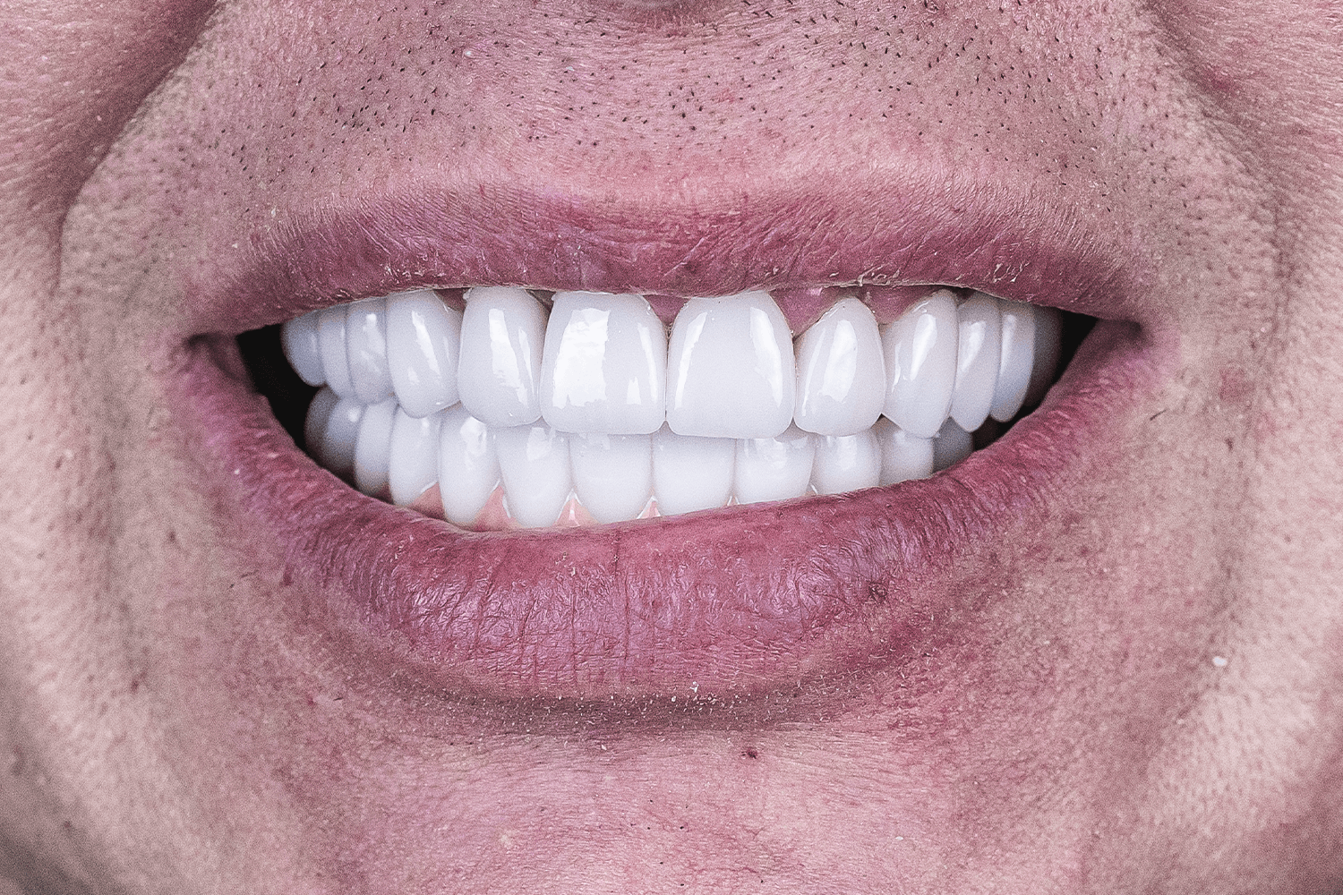 Тотальне протезування коронками на імплантах Straumann