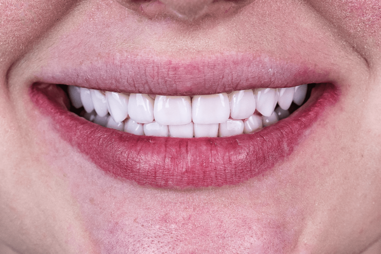 Тотальное протезирование винирами и коронками e.max