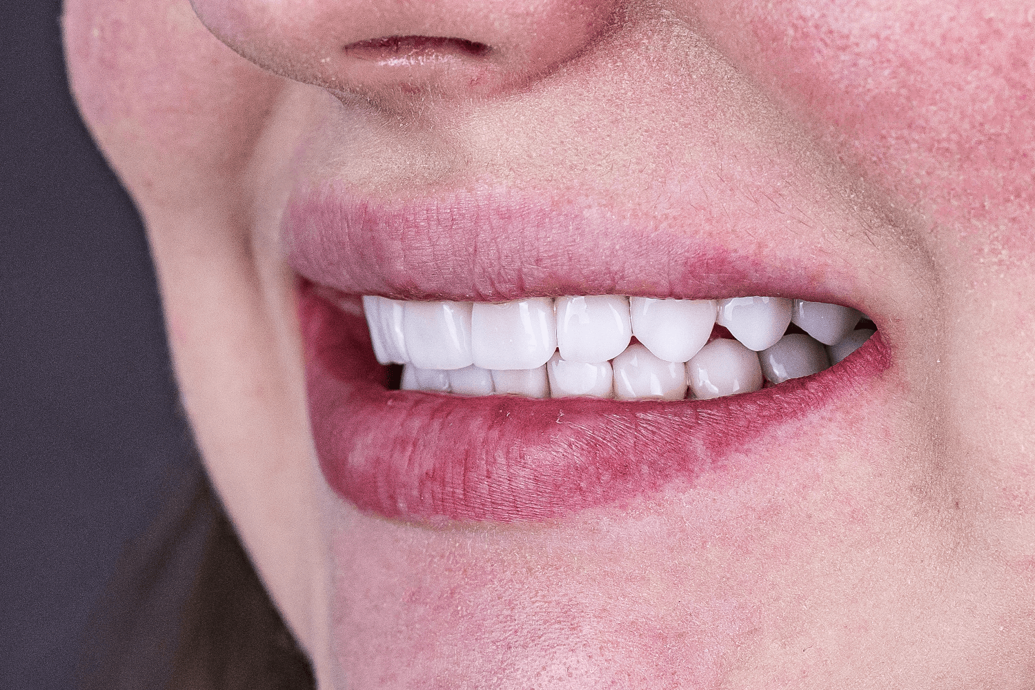 Тотальне протезування вінірами й коронками e.max