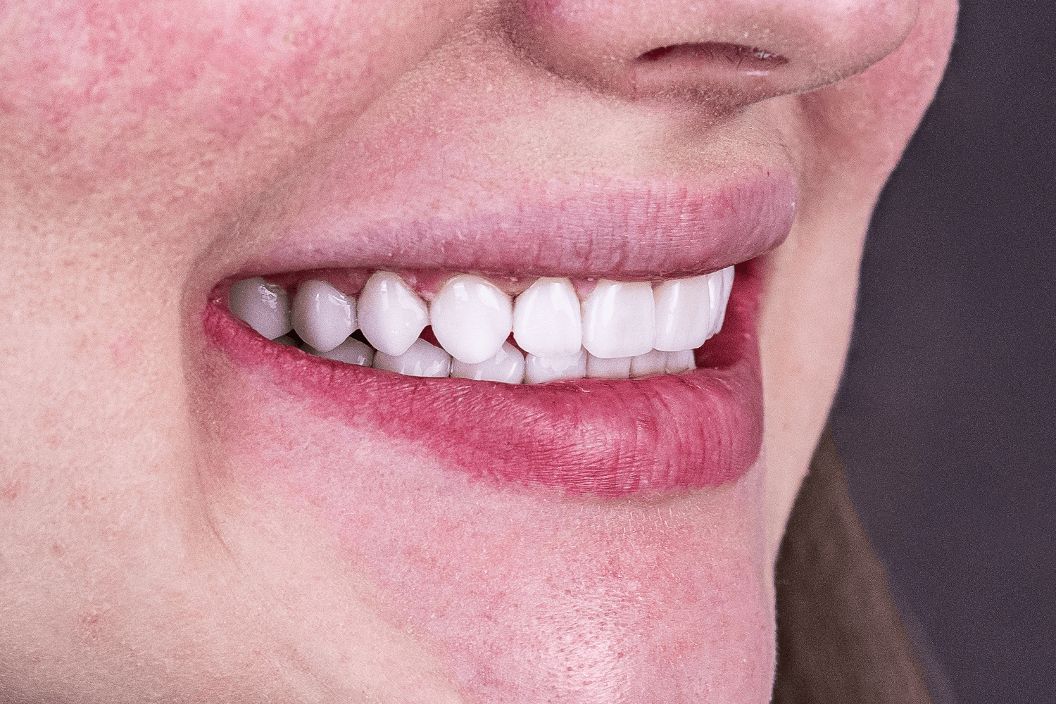 Тотальне протезування вінірами й коронками e.max