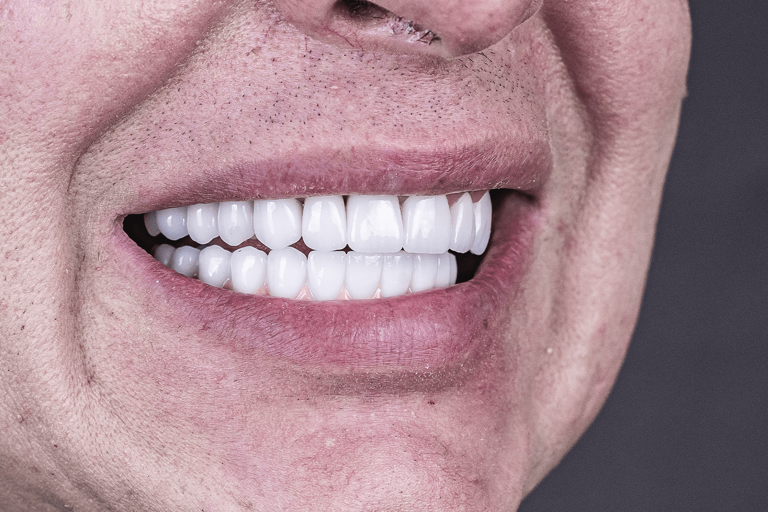 Тотальне протезування коронками на імплантах Straumann