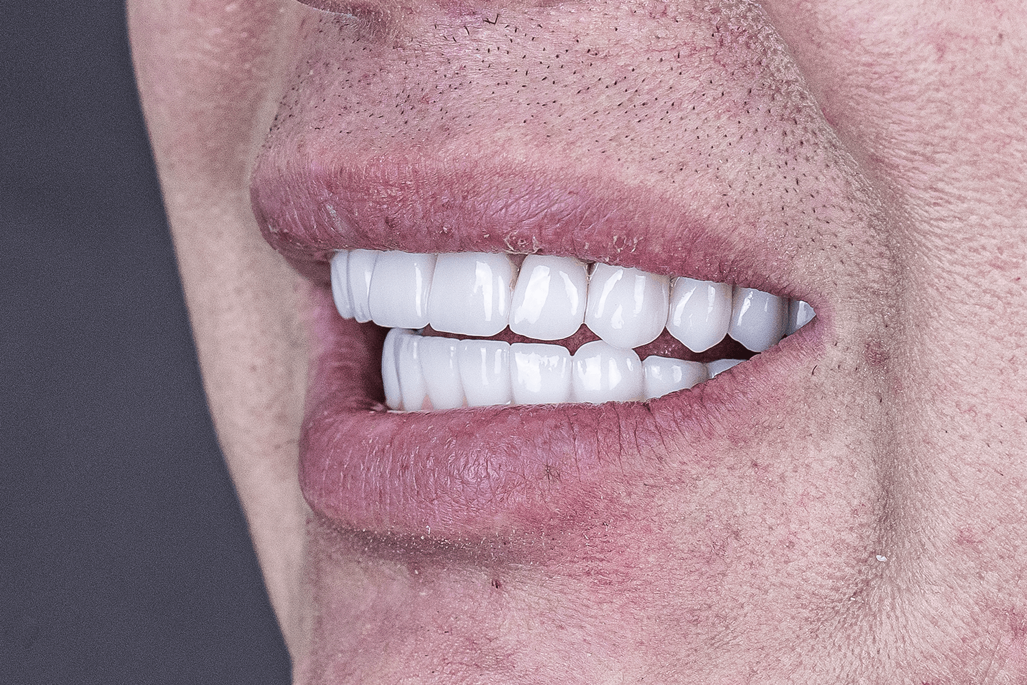 Тотальне протезування коронками на імплантах Straumann