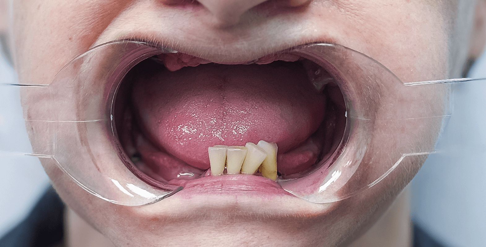 Встановили керамічні зубні протези на імплантах