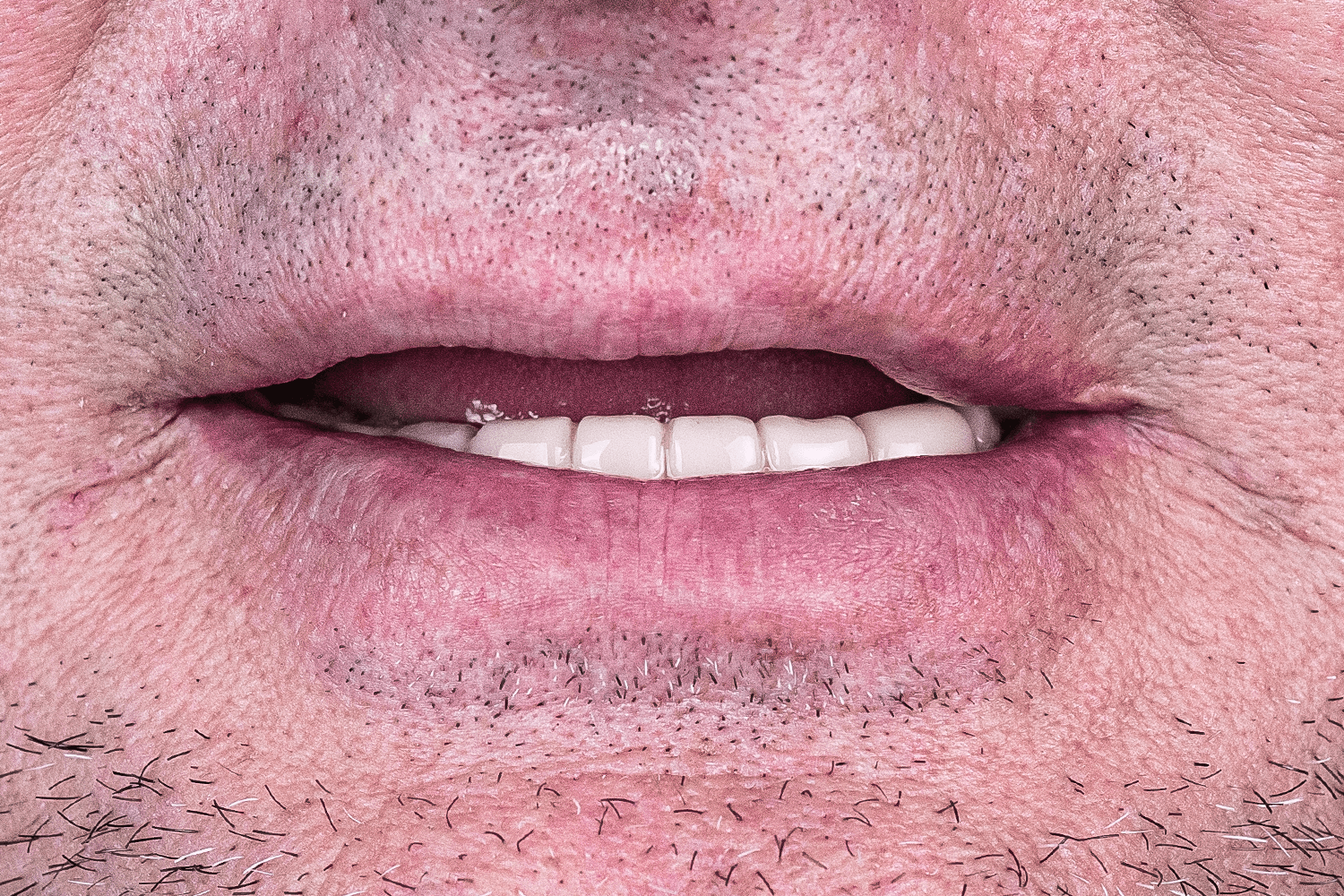 Протезування верхньої щелепи на імплантах для військового