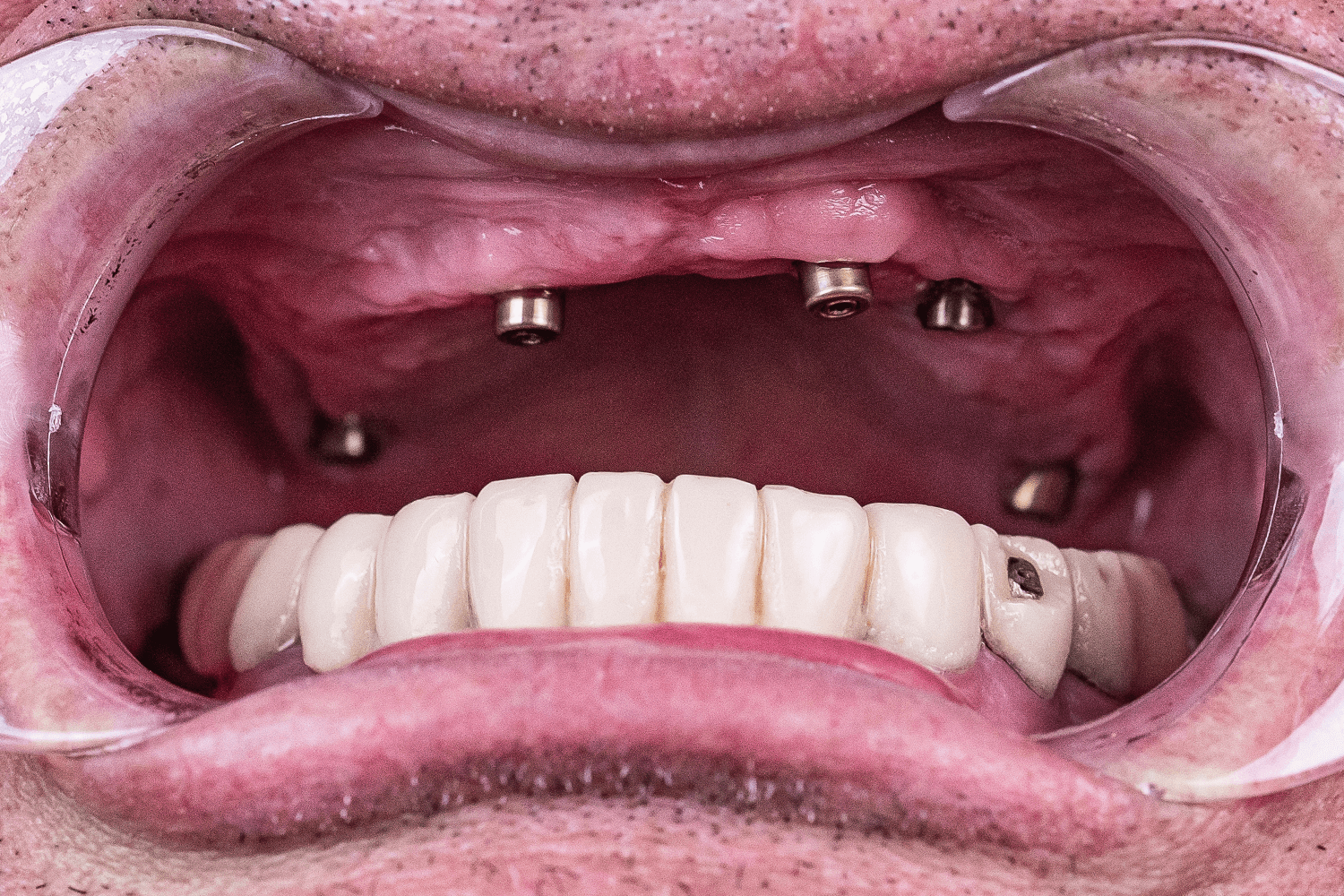 Протезування верхньої щелепи на імплантах для військового