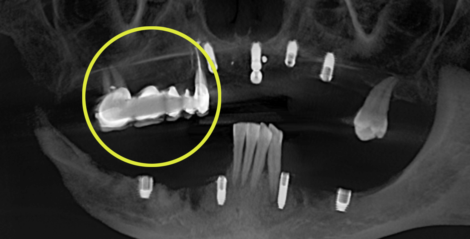 Встановили керамічні зубні протези на імплантах