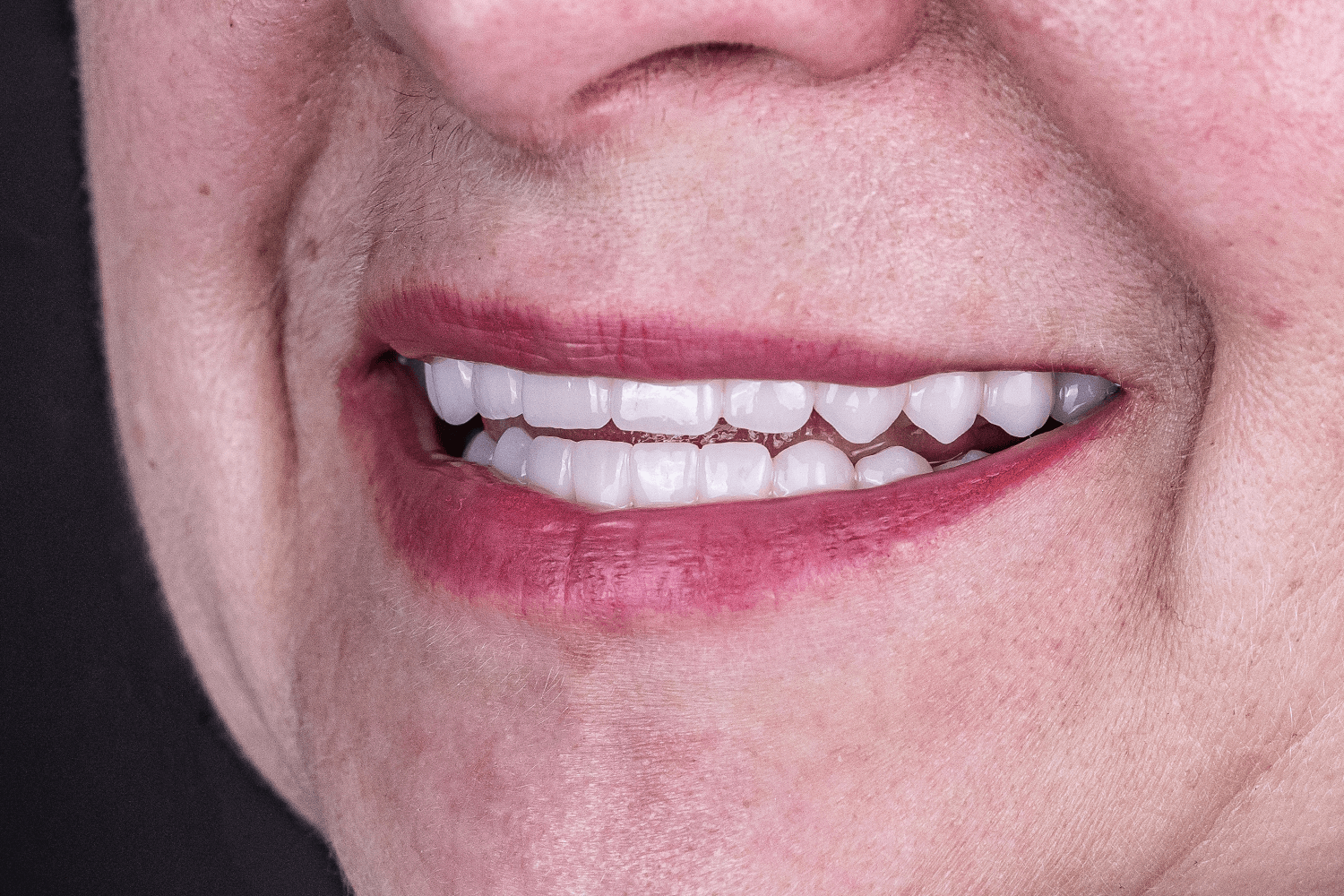 Встановили керамічні зубні протези на імплантах