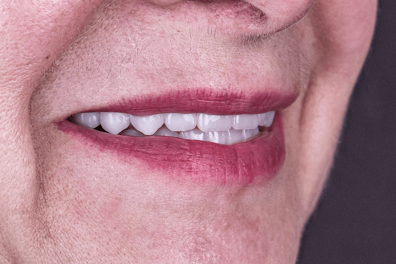 Встановили керамічні зубні протези на імплантах