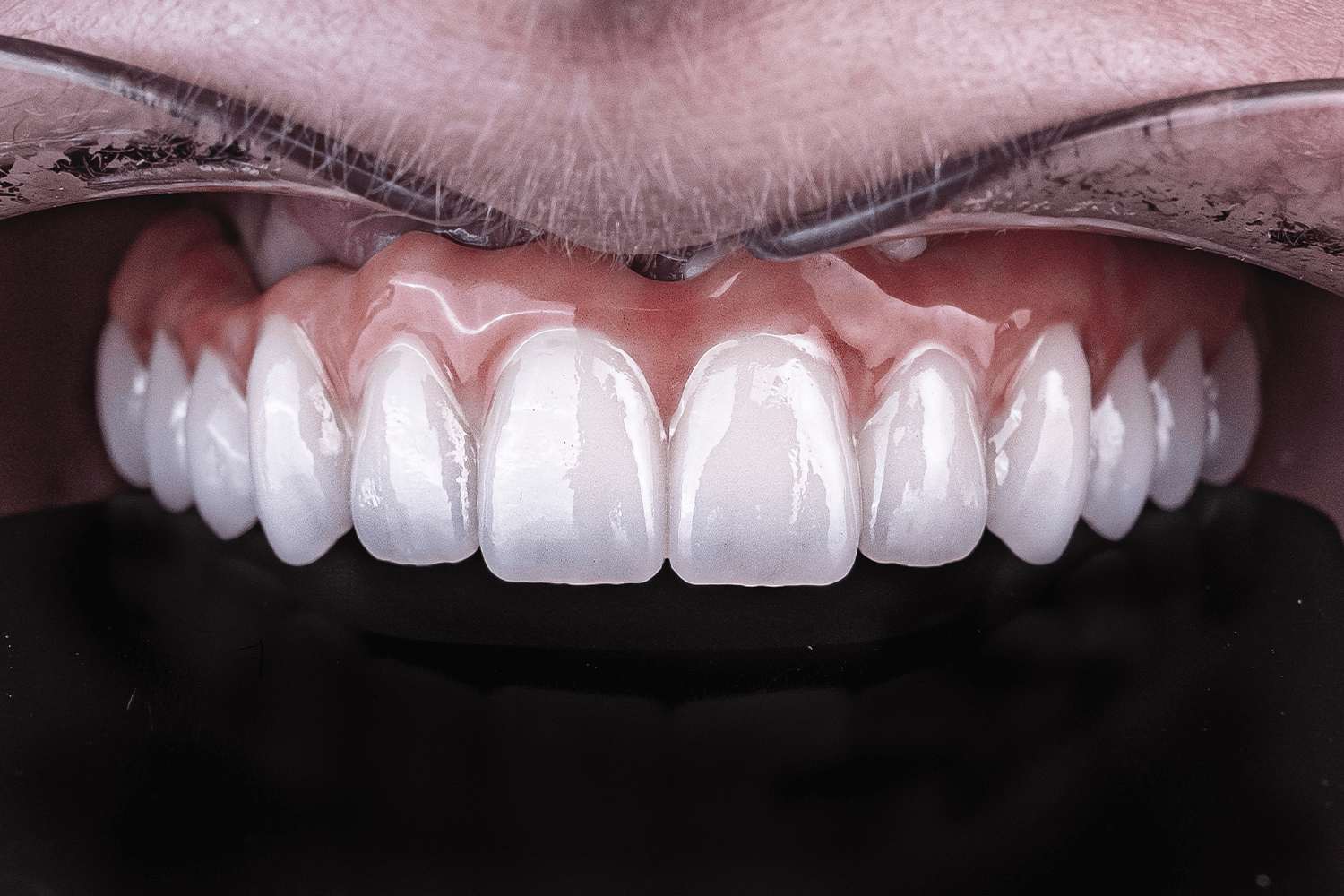 Встановили керамічні зубні протези на імплантах