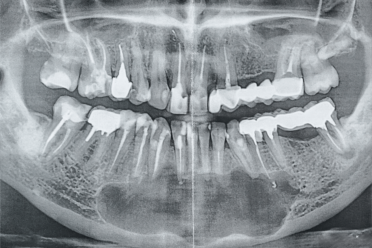 Лікування кісти без видалення зуба