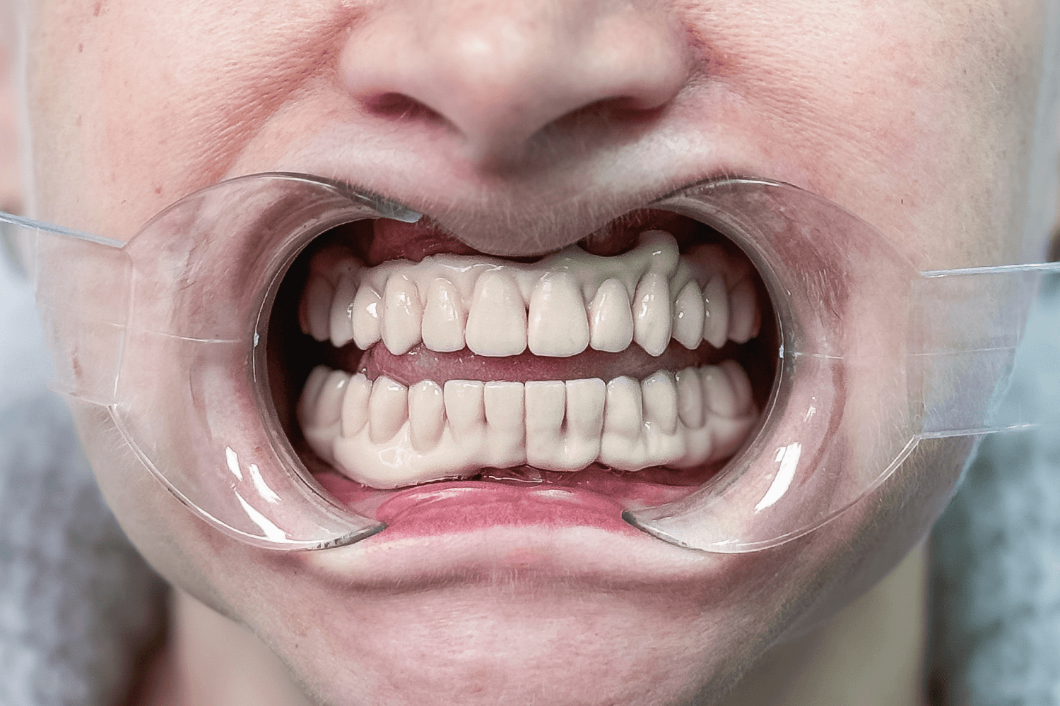 Встановили керамічні зубні протези на імплантах