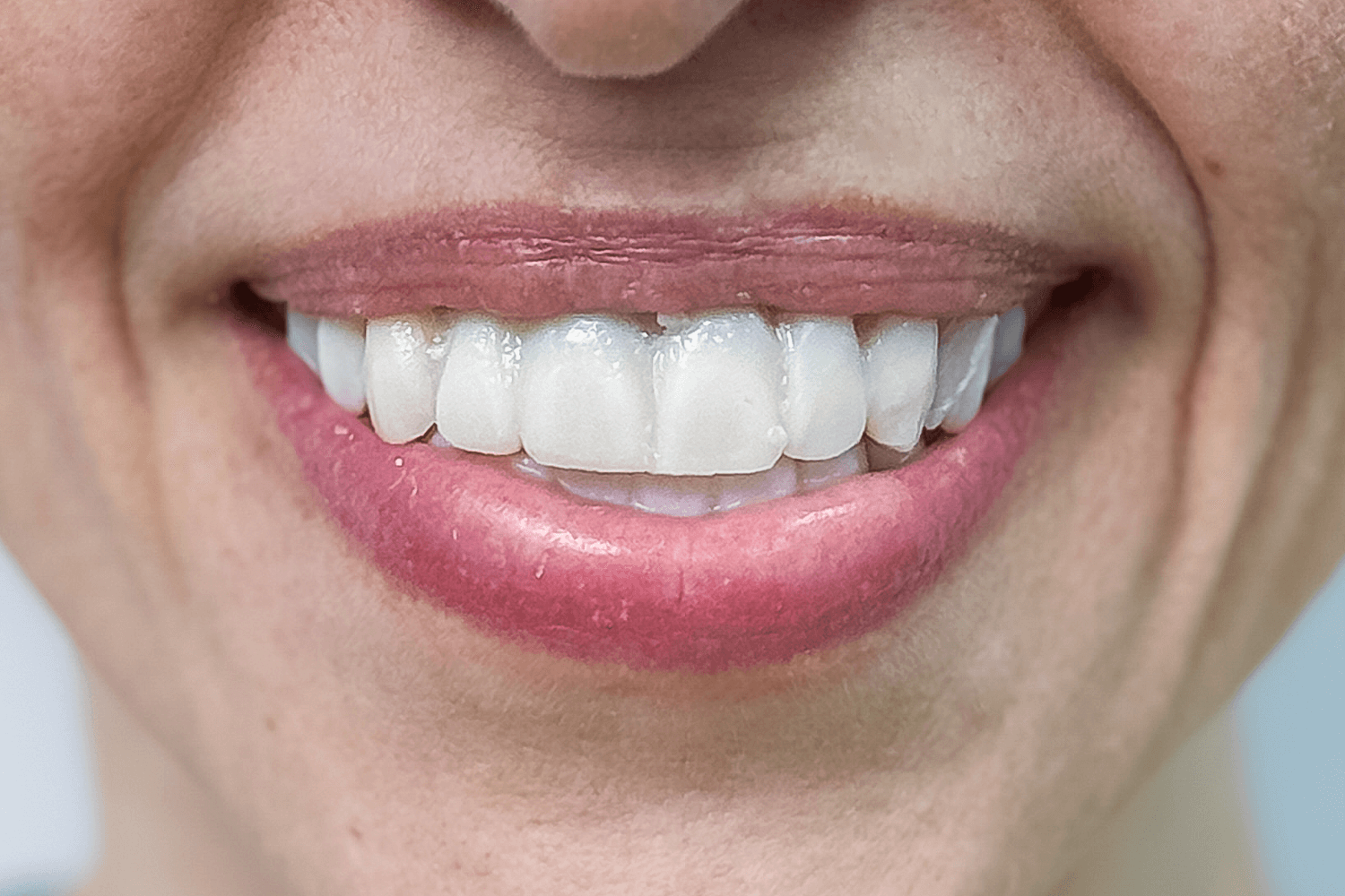 Протезування коронками та вінірами e.max