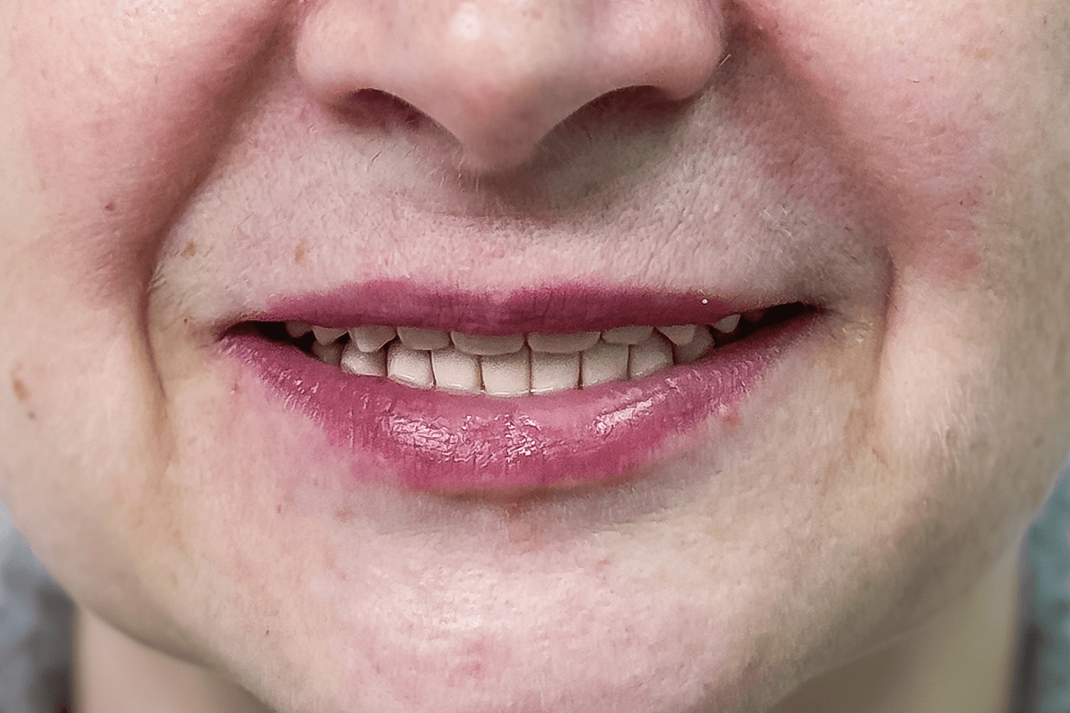 Встановили керамічні зубні протези на імплантах