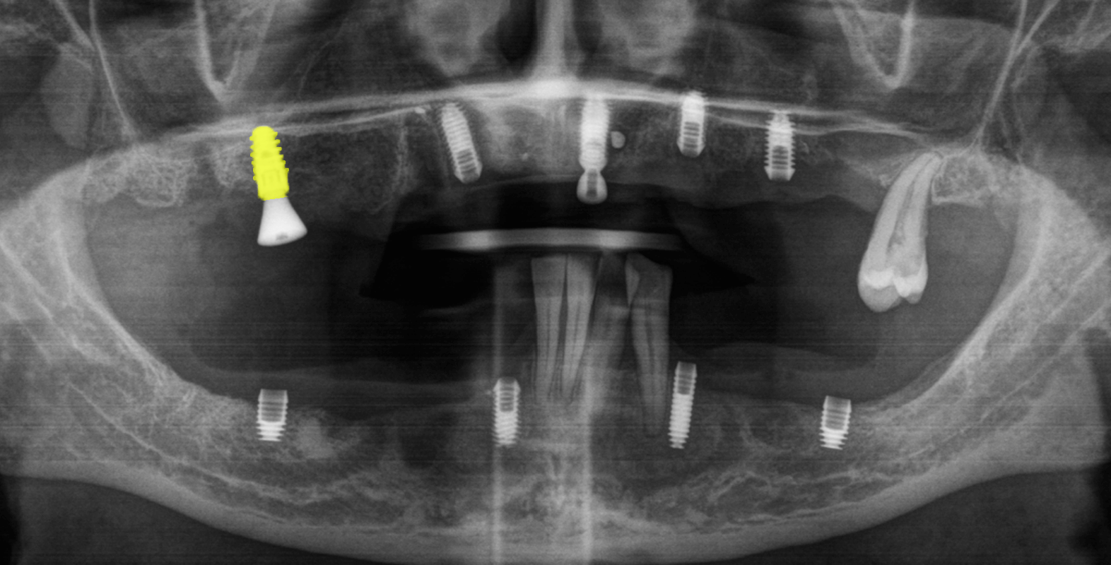 Встановили керамічні зубні протези на імплантах