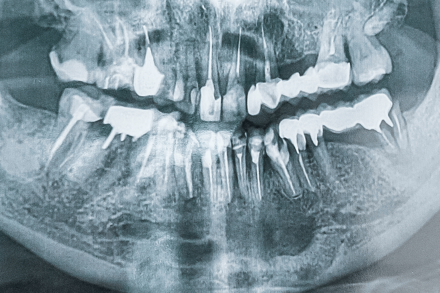 Лікування кісти без видалення зуба