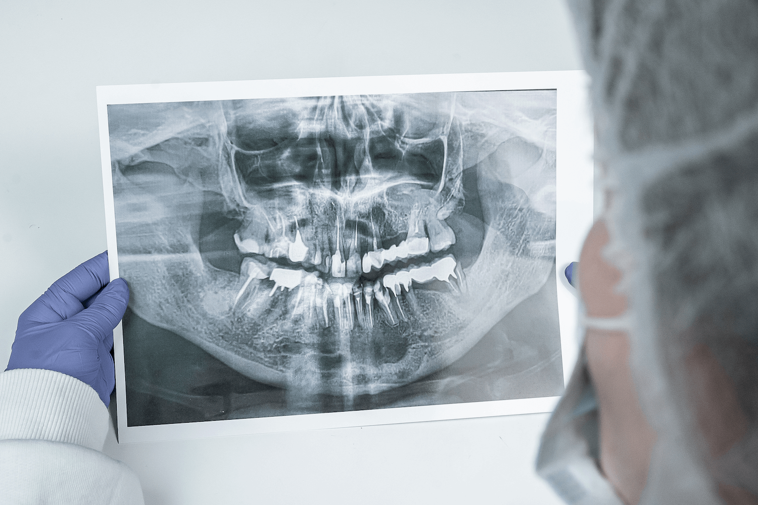 Лікування кісти без видалення зуба