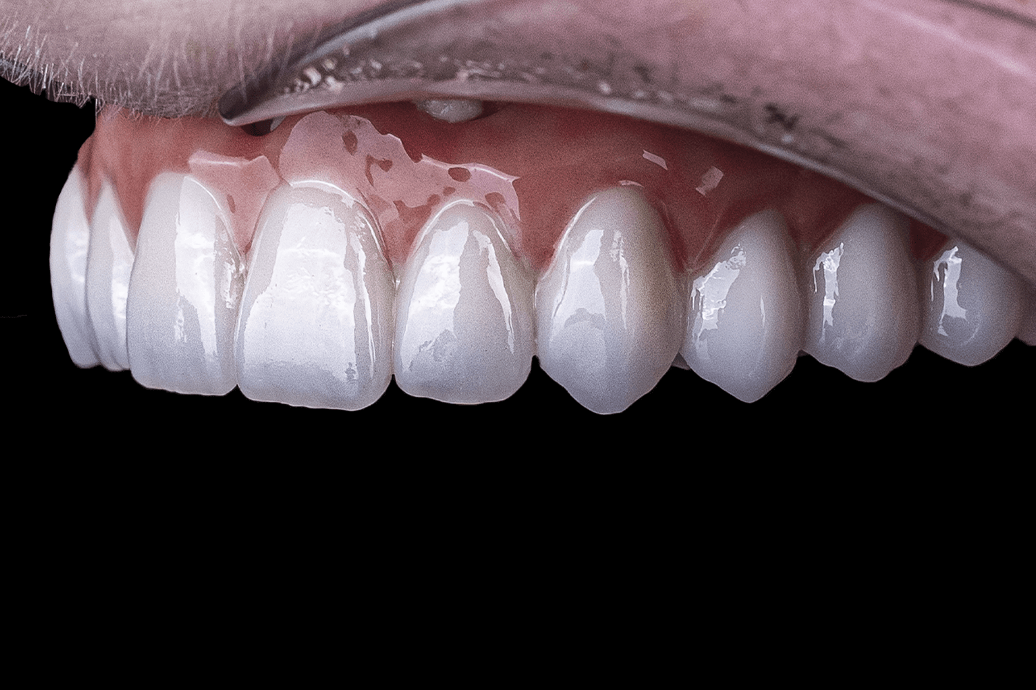 Встановили керамічні зубні протези на імплантах