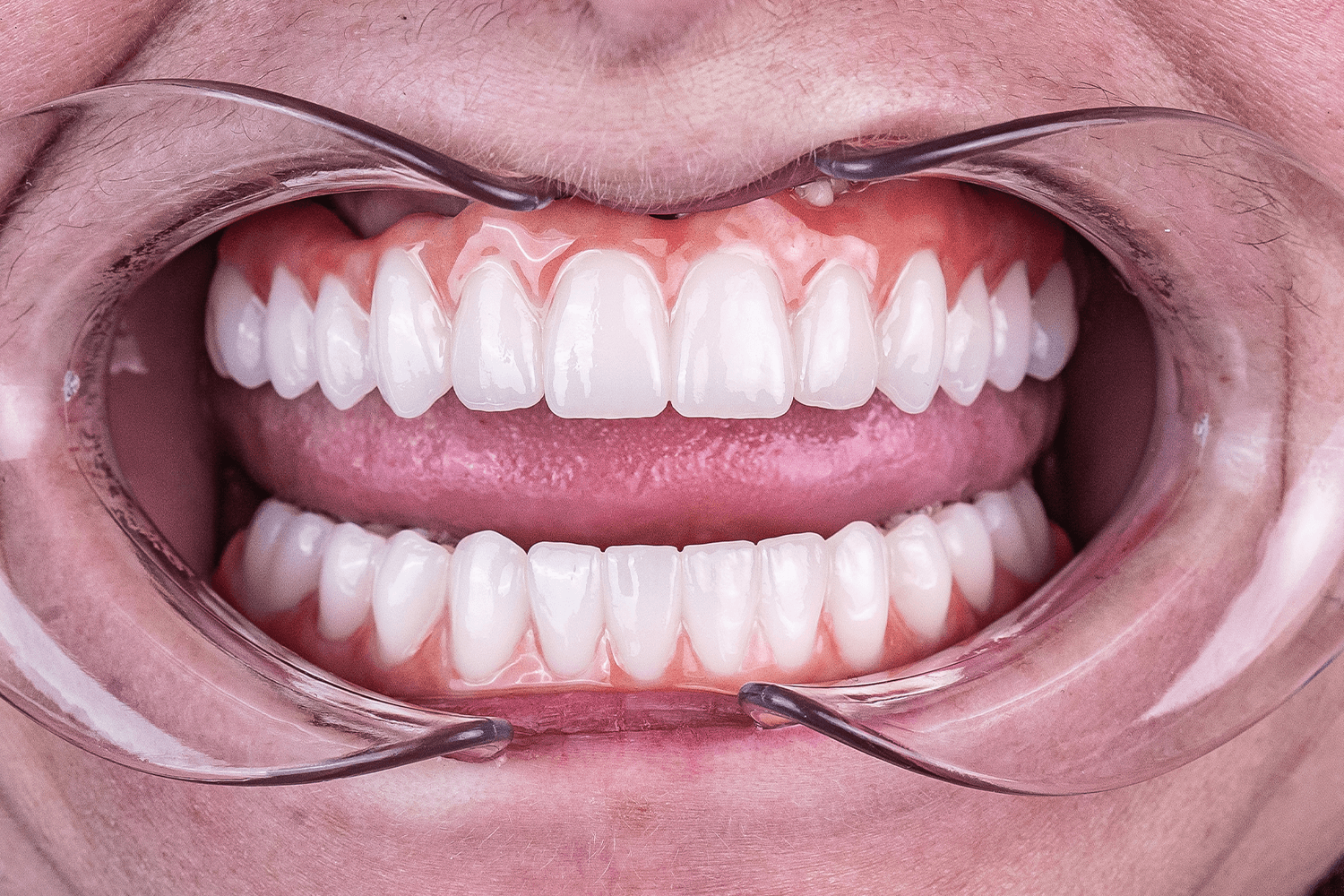 Встановили керамічні зубні протези на імплантах