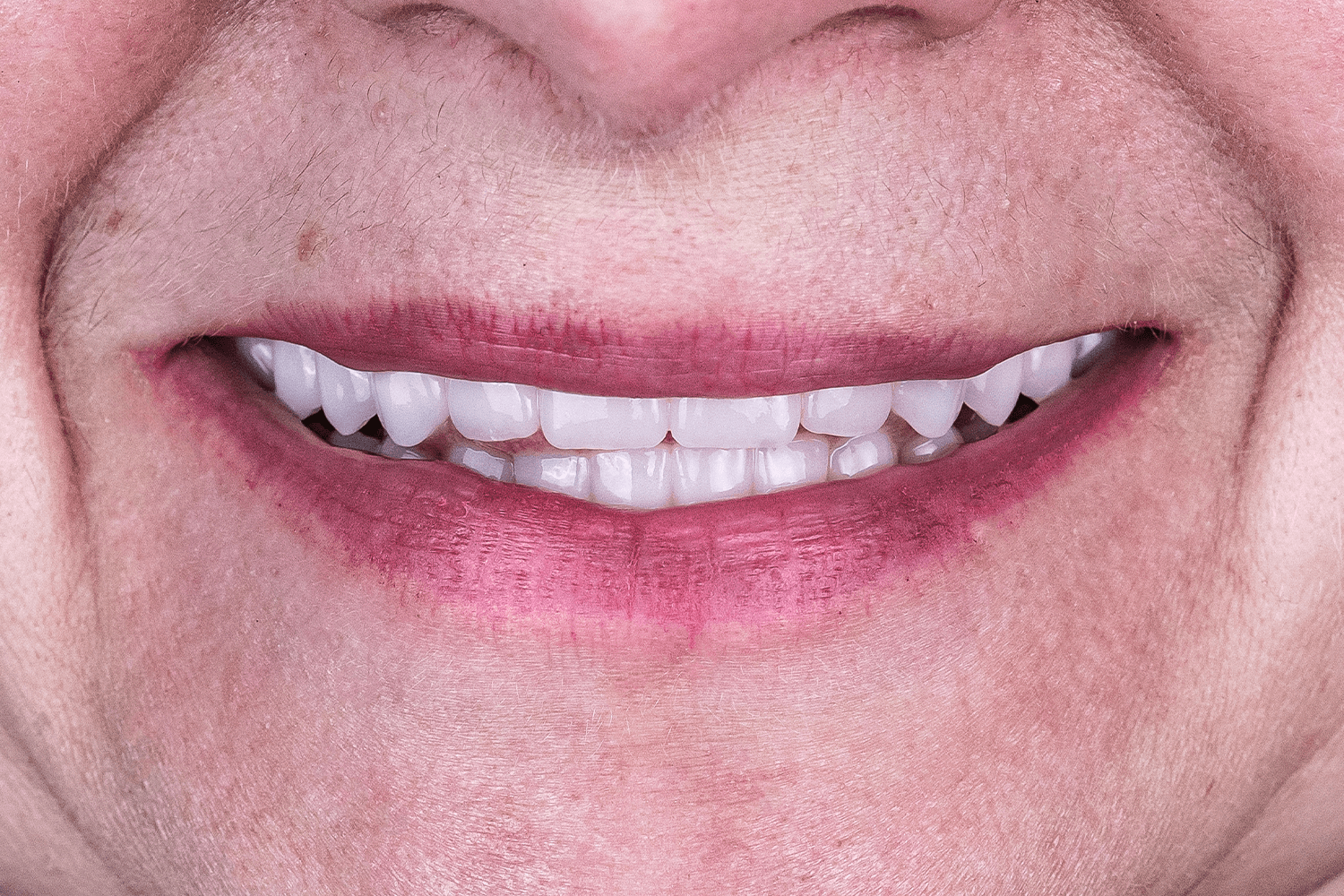 Встановили керамічні зубні протези на імплантах