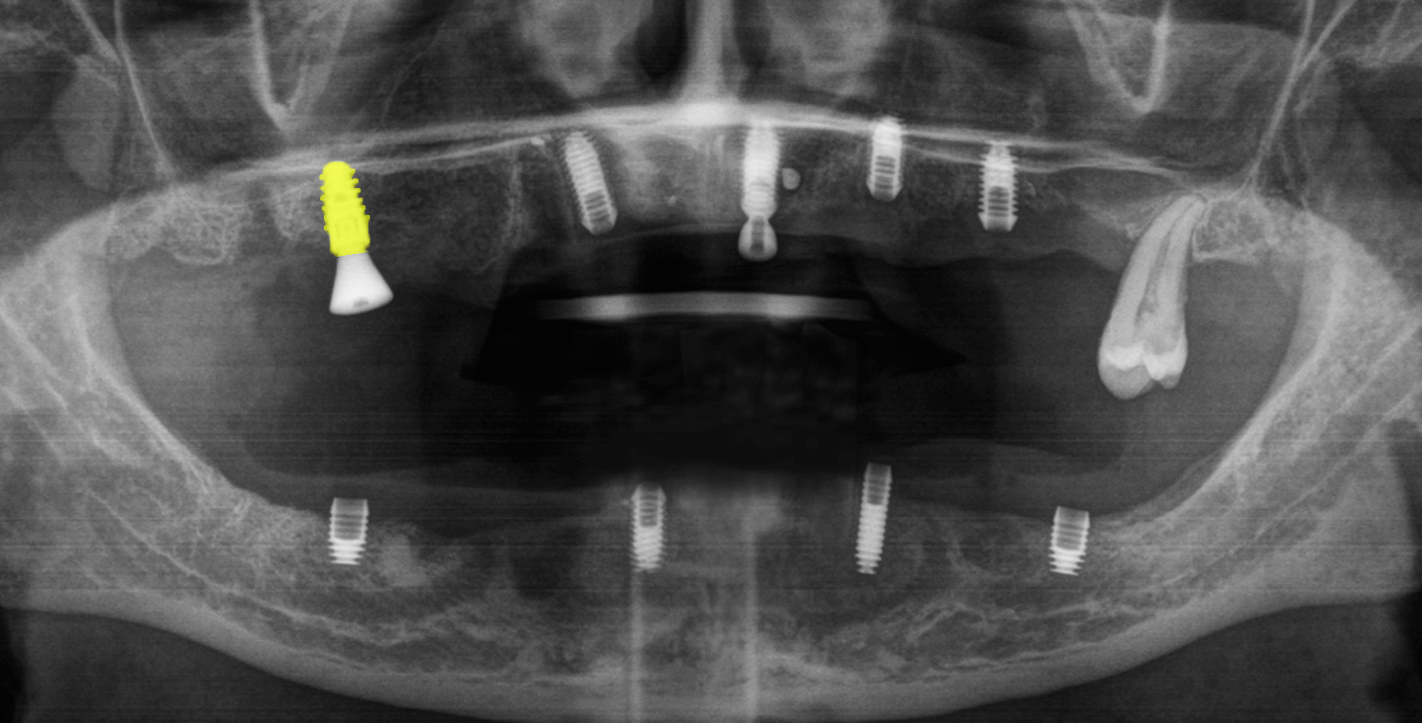 Встановили керамічні зубні протези на імплантах