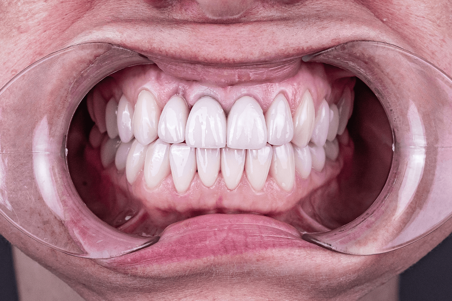 Протезування коронками та вінірами e.max