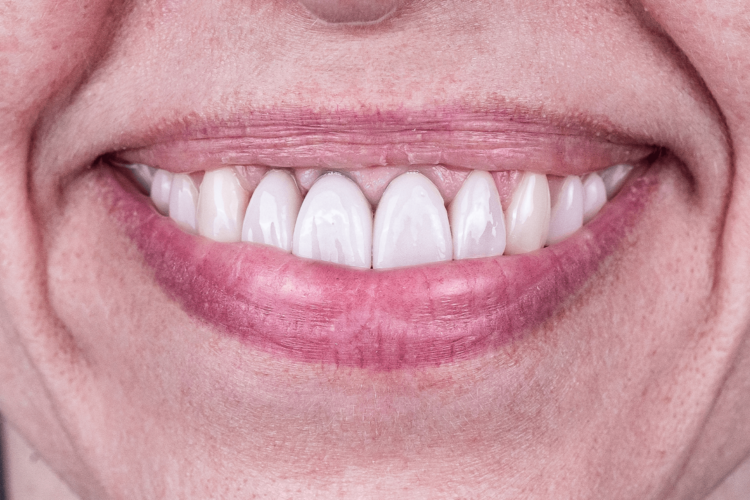 Протезирование коронками и винирами e.max