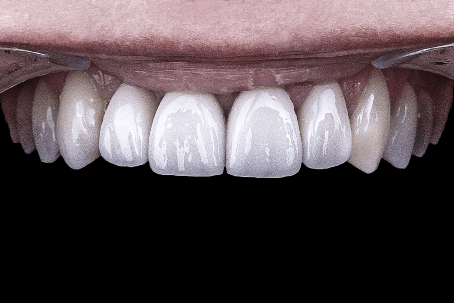 Протезування коронками та вінірами e.max