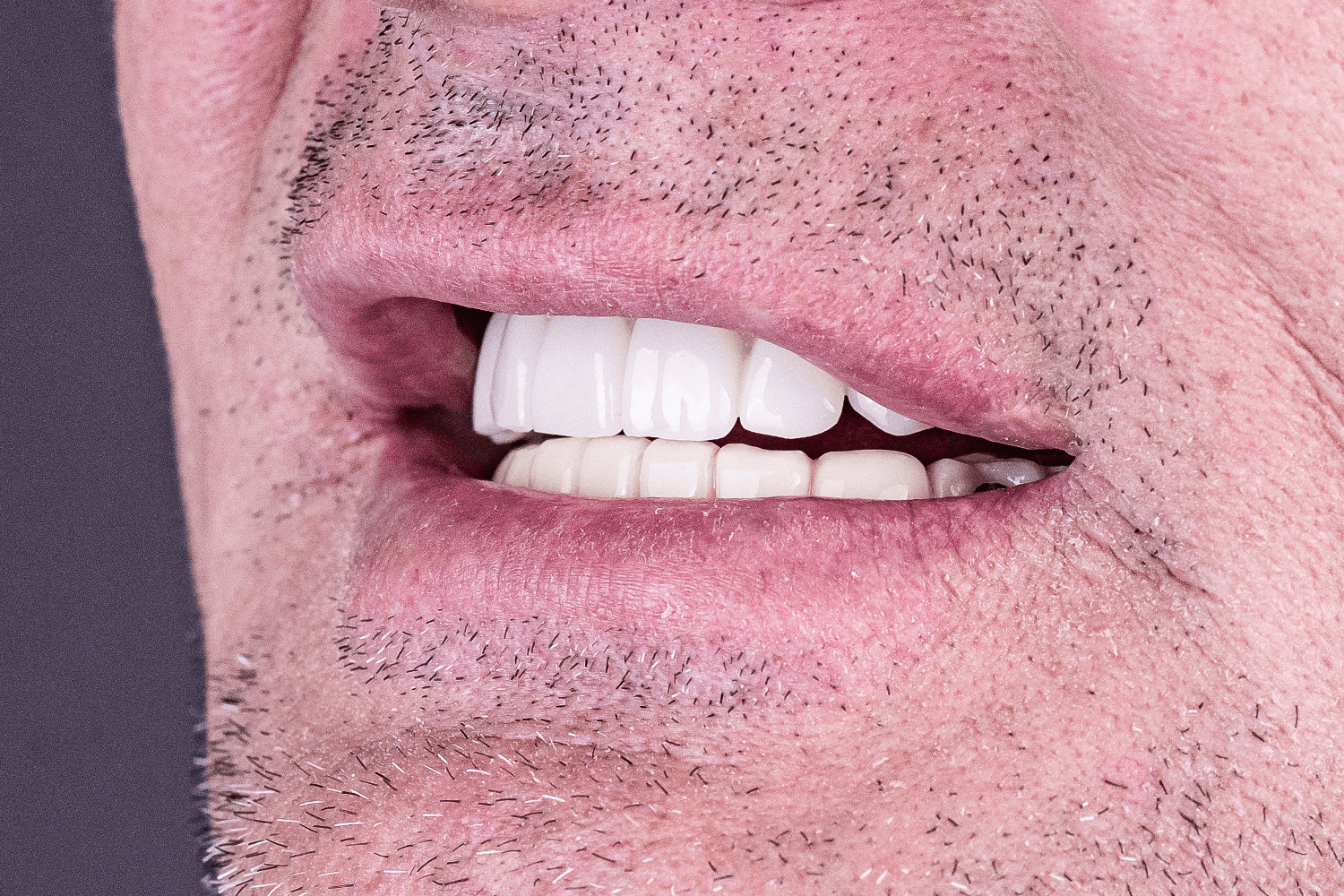 Протезування верхньої щелепи на імплантах для військового