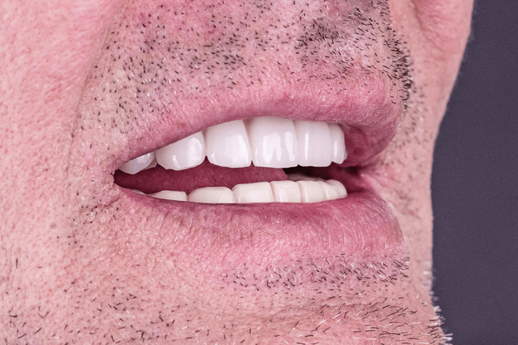 Протезирование верхней челюсти на имплантах для военнослужащего