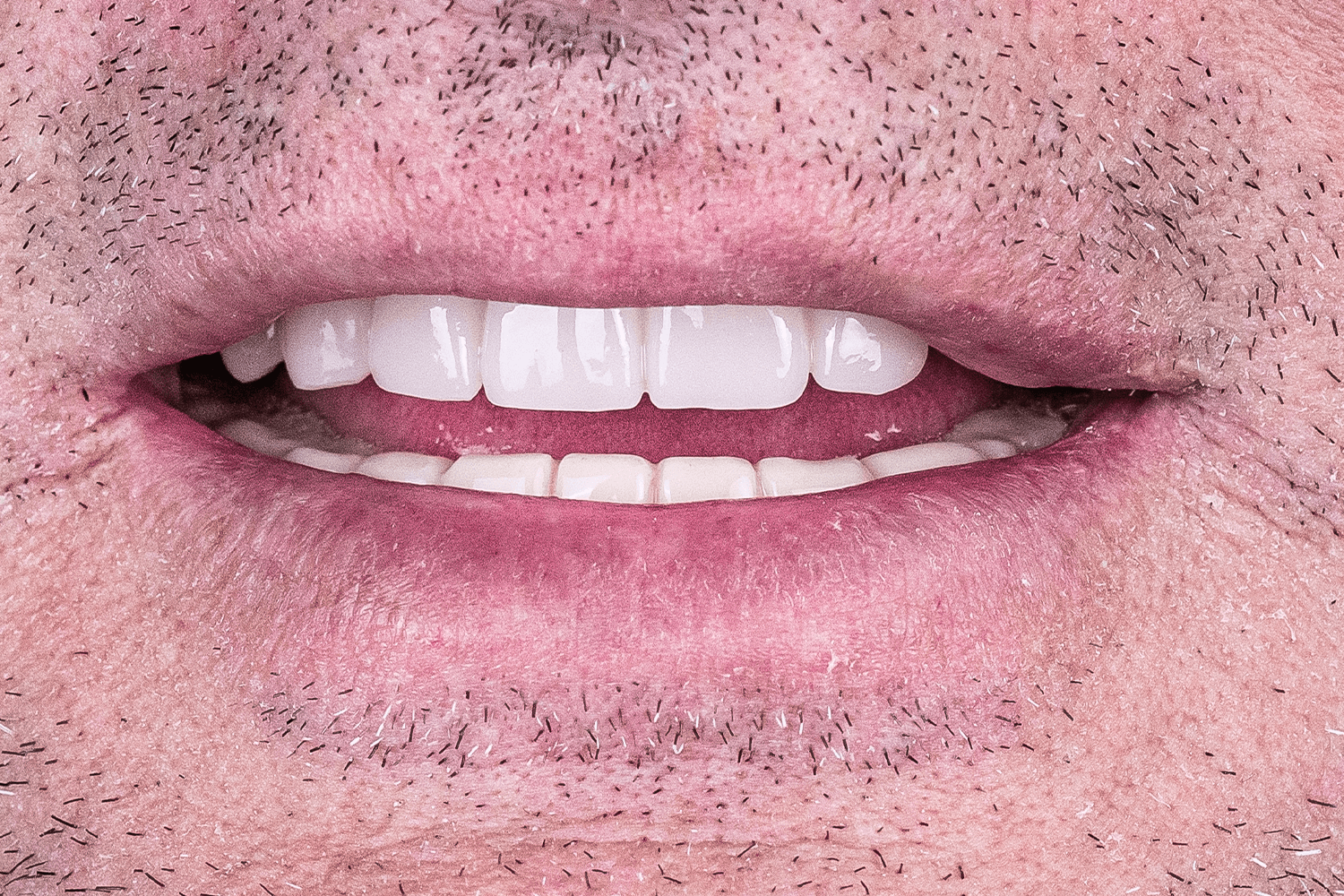 Протезування верхньої щелепи на імплантах для військового