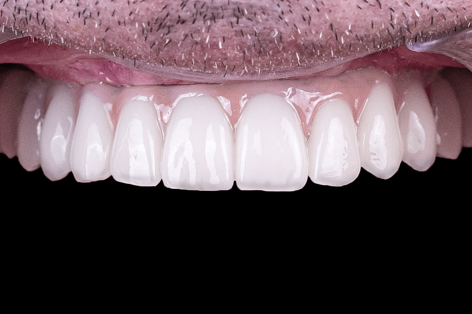 Протезування верхньої щелепи на імплантах для військового