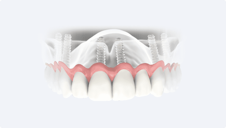 Що краще – зубні імпланти чи мостоподібний протез