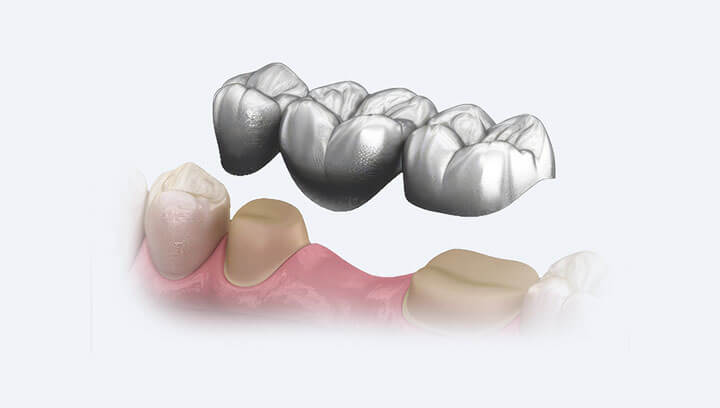 Що краще – зубні імпланти чи мостоподібний протез