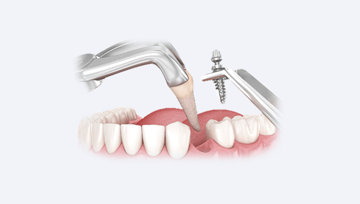 Що краще – зубні імпланти чи мостоподібний протез