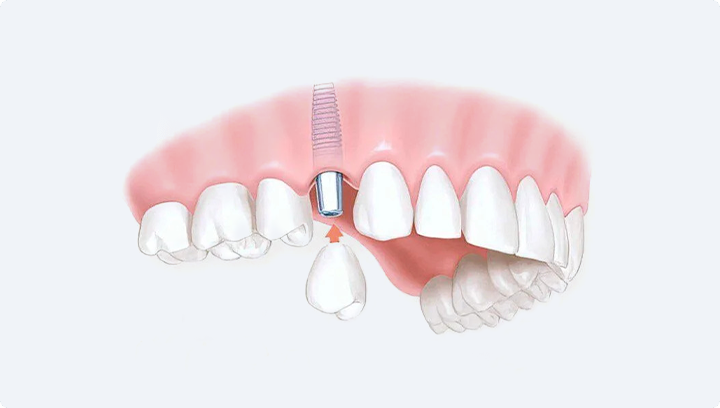 Що краще – зубні імпланти чи мостоподібний протез