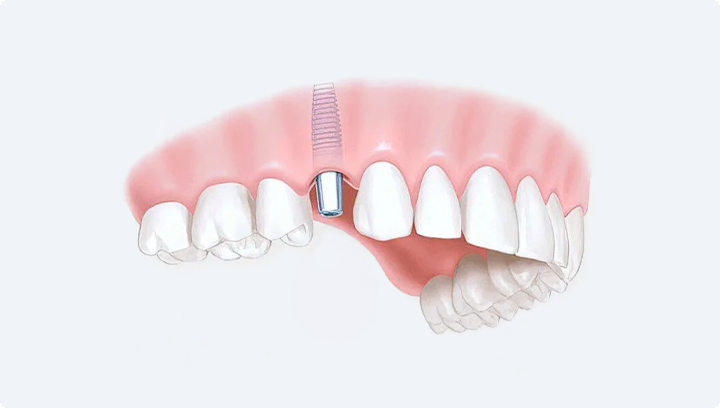 Що краще – зубні імпланти чи мостоподібний протез