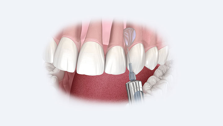 Рецесія ясен: опустилися ясна, що робити?