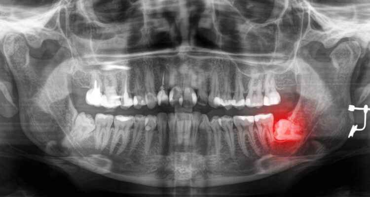 Видалення зубів мудрості. Часті питання
