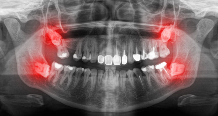 Видалення зубів мудрості. Часті питання
