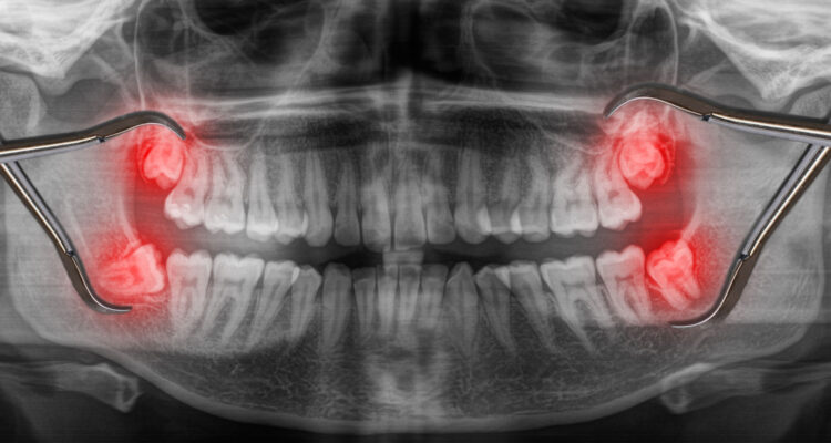Видалення зубів мудрості. Часті питання